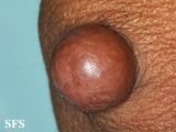 proliferating trichilemmal cyst