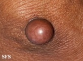 proliferating trichilemmal cyst