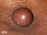 proliferating trichilemmal cyst