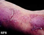 sneddon-wilkinson disease