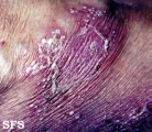 sneddon-wilkinson disease