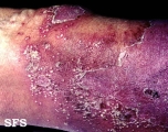 sneddon-wilkinson disease