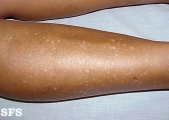 idiopathic guttate hypomelanosis