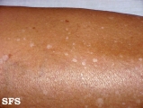 idiopathic guttate hypomelanosis