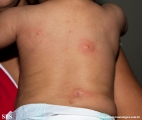 mastocytoma
