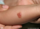 mastocytoma