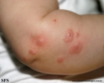 mastocytoma