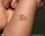 mastocytoma