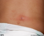 mastocytoma