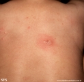 mastocytoma