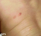 mastocytoma