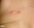mastocytoma