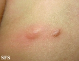 mastocytoma