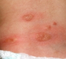 mastocytoma