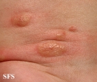 mastocytoma