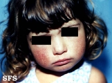 thomson's disease