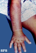thomson's disease