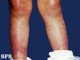 thomson's disease