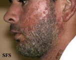 sycosis vulgaris