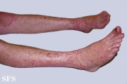 allergic vasculitis
