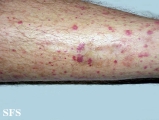 allergic vasculitis