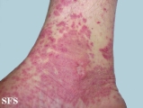 allergic vasculitis