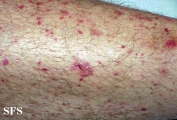 allergic vasculitis