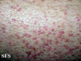 allergic vasculitis