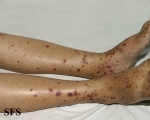 allergic vasculitis