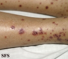 allergic vasculitis