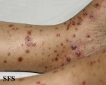allergic vasculitis