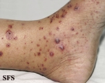 allergic vasculitis