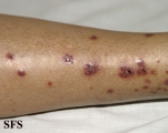 allergic vasculitis