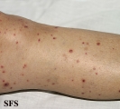 allergic vasculitis