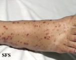 allergic vasculitis