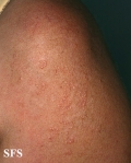 actinic granuloma