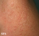 actinic granuloma