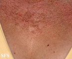 actinic granuloma