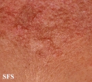 actinic granuloma