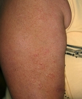 actinic granuloma