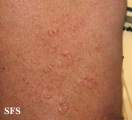 actinic granuloma