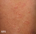 actinic granuloma