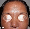 scleromyxedema