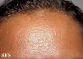 scleromyxedema