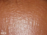 scleromyxedema