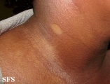 scleromyxedema
