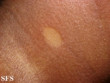scleromyxedema