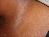 scleromyxedema