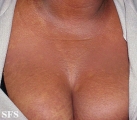 scleromyxedema