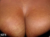 scleromyxedema